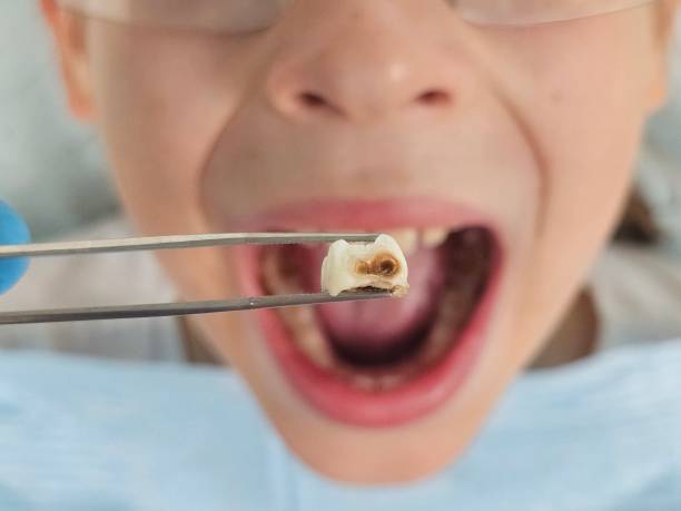 Best Urgent Care for Lost Fillings or Crowns in Naples Manor, FL